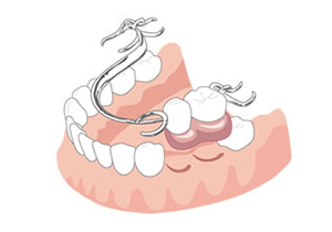 部分入れ歯の場合